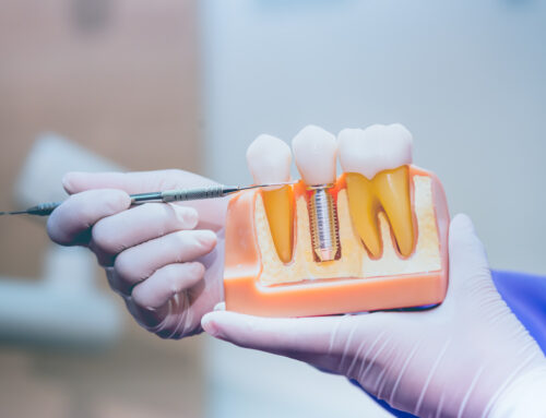 Dental Implants: A Guide for Patients