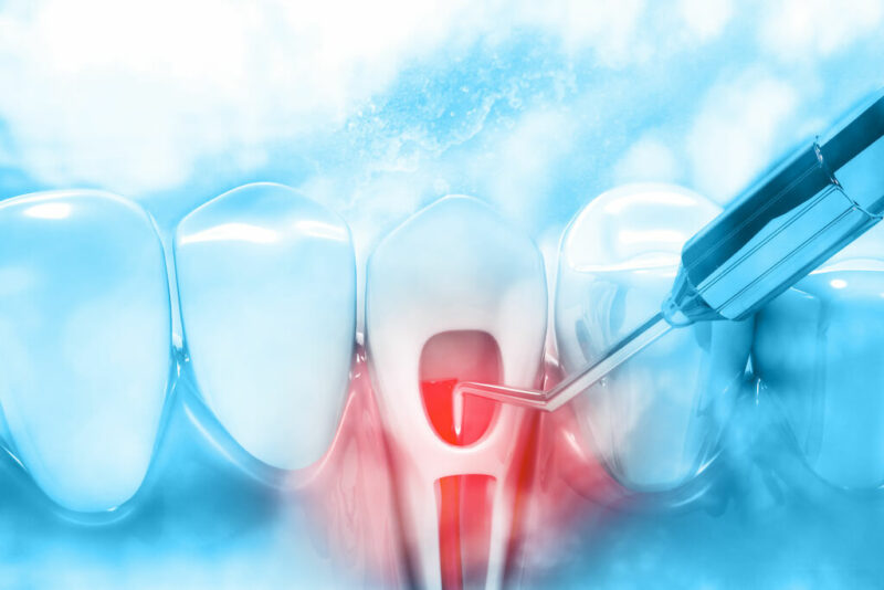 Laser Assisted Root Canal Treatment Brooklyn, NY Onatsky Dental Clinic