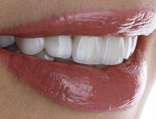 Are Porcelain Veneers Right For You?